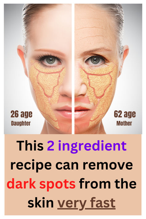 Lighten dark spots naturally with lemon juice, aloe vera, or products containing licorice extract or vitamin C, and use sunscreen for protection #skin #sunspots #lighterskin #darkspots Darkspots Skincare, Rid Wrinkles, Apple Cider Vinegar For Skin, How To Fade, Wrinkle Remedies, Wrinkle Free Skin, Dark Spots On Face, Spots On Face, Skin Specialist