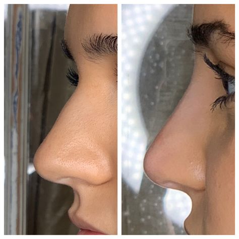 Straight Button Nose, Straight Nose With Bump, Straight Nose Front View, Rhinoplasty Inspiration, Straight Nose Side Profile, Nose Filler, Smooth Nose, Nose Fillers, Upturned Nose