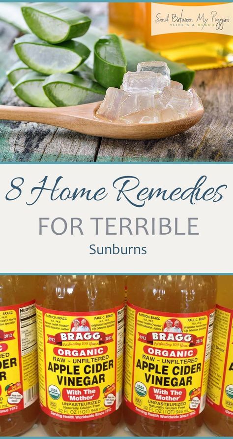 8 Home Remedies for Terrible Sunburns How To Help Sunburn, Home Remedies For Sunburn, Natural Remedies For Sunburn, Stuffy Nose Remedy, Sunburn Remedies, Natural Headache Remedies, Holistic Health Remedies, Holistic Remedies, Natural Therapy