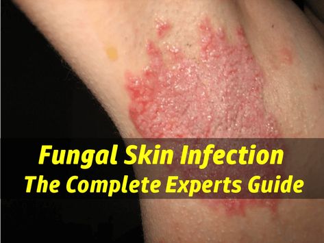 Skin Fungus Experts Guide: learn how to identify the causes & types of skin fungal infections, proper way to treat, and common critical mistakes to avoid. Yeast Infection On Skin, Skin Fungus, Skin Lightening Diy, Fungal Infection Skin, Flaking Skin, Skin Care Routine Order, Dry Itchy Skin, Saggy Skin, Fungal Infection