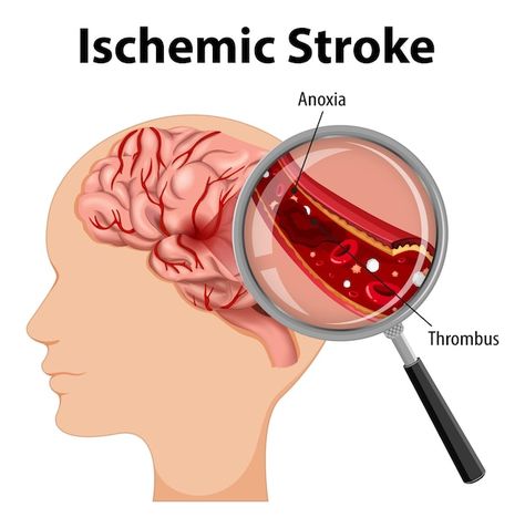 Free vector human with ischemic stroke | Free Vector #Freepik #freevector #physiology #science-cartoon #arteries #anatomy Cells And Tissues, Severe Headache, Medical Photos, Surprising Facts, Why Do People, Blood Vessels, Emergency Medical, Balanced Diet, Headache