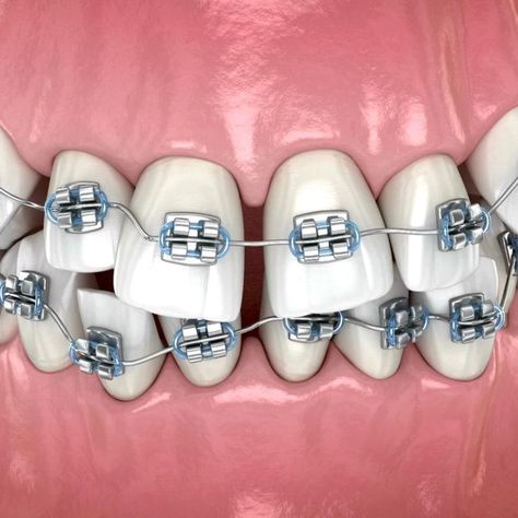 Orthodontics Marketing, Orthodontics Teeth, Damon Braces, Dental Wallpaper, Dental Advertising, Misaligned Teeth, Dental Posts, Dental Posters, Dental Aesthetics