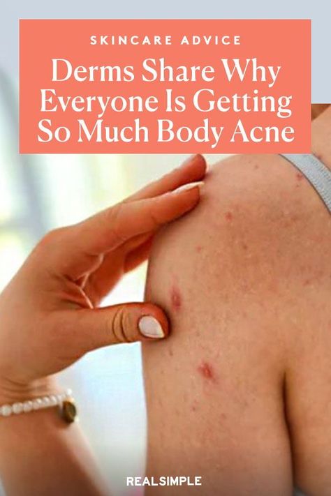 Arm Acne, Body Pimples, Acne Reasons, Back Acne Remedies, Chest Acne, Acne Body Wash, Blind Pimple, Forehead Acne, Pimples Under The Skin