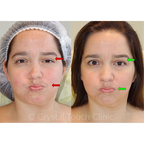 Bells Palsy, Nose Shapes, Face Exercises, Cosmetic Surgery, Facial, Yoga