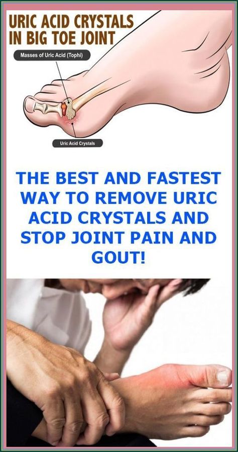 The Best And Fastest Way To Remove Uric Acid Crystals And Stop Joint Pain And Gout Uric Acid Crystals, Uric Acid, Foot Pain, Digestion Problems, Health Remedies, Health Problems, Pain Relief, How To Stay Healthy, Natural Remedies