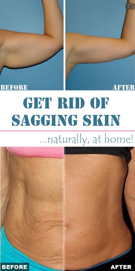 6 Wonderful home remedies for sagging skin Remedies For Skin, For Skin Tightening, Home Remedies For Skin, Crepey Skin, Saggy Skin, Beauty Remedies, Skin Remedies, Trening Abs, Loose Skin