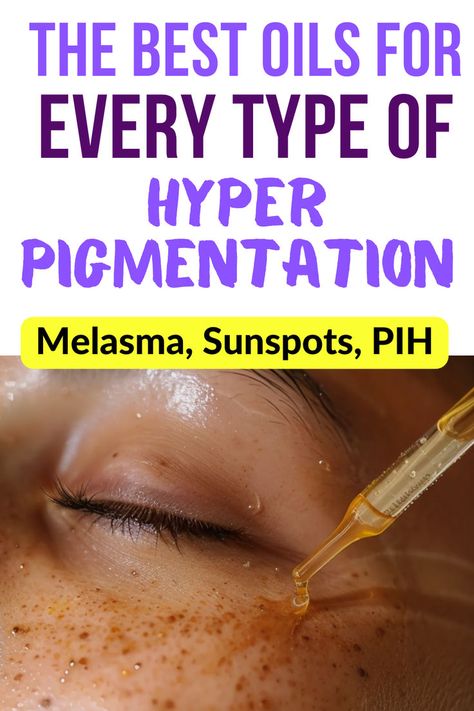 Woman being treated for hyperpigmentation with oil. Text reads: The best oils for every type of hyperpigmentation. Melasma, sunspots, PIH. Scientifically proven. Home Remedies For Face, Removing Hyperpigmentation, Skin Care Home Remedies, Dark Spots On Face, Dry Skin Body, Dry Skin Remedies, Dark Spots On Skin, Spots On Face, Winter Skin Care