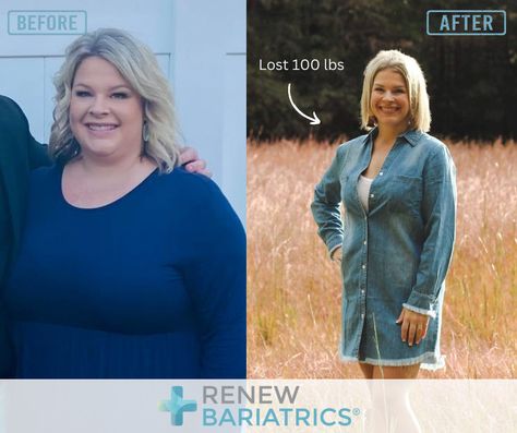 Discover Inspiring Gastric Sleeve Before and After Photos. Read VSG Testimonials, and Success Stories of our Gastric Sleeve Patients. Vsg Before And After, Bariatric Sleeve, How To Help Nausea, Sleeve Surgery, Before After Photo, Medical Tourism, After Pictures, You Loose, After Surgery