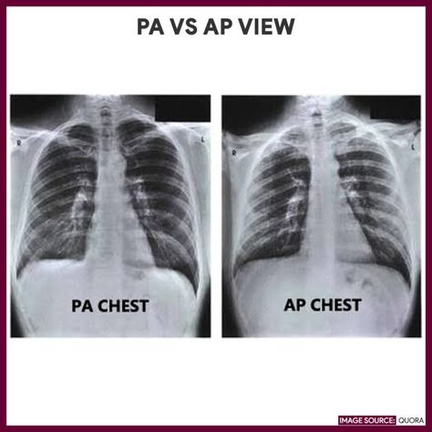 Chest X-ray (Chest Radiography) Nurse Study Guide  In posteroanterior (PA) view, the front part of the ribs is clearer (the more tilted part), while in anteroposterior (AP) view, the back portion of the ribs (horizontal part) along with scapula is clearer.  Learn more about it here Diagnostic Radiography, Radiography Student, Medical Radiography, Nurse Study, Radiology Student, Radiology Technician, Nursing Study Guide, Basic Anatomy And Physiology, Nursing Care Plan