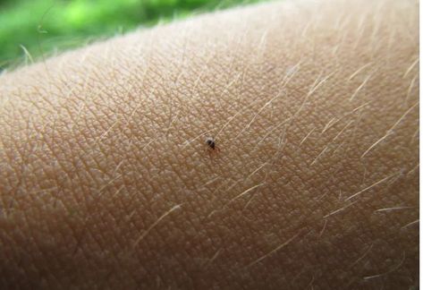 A tick bite can make you allergic to red meat. Chronic Lyme, Tick Bite, Walk In The Woods, Red Meat, Get Outside, Ticks, Home Remedies, Stud Earrings, Skin