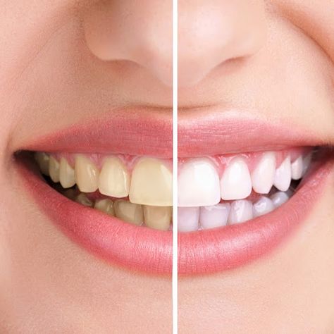 Teeth Whitening at Jamnagar Dr. Bharat Katarmal Aesthetic Dentistry, Porcelain Veneers, Implant Dentistry, Teeth Braces, Dental Veneers, Skin Spots, Natural Teeth Whitening, Natural Teeth, Health Skin Care