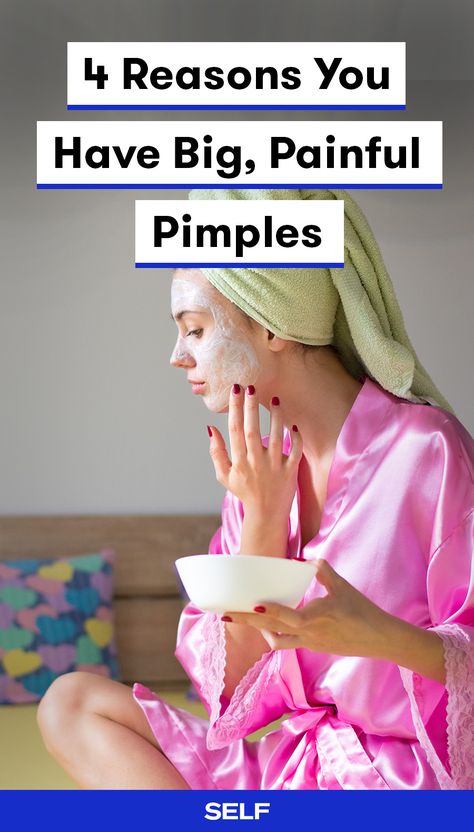 Unlike whiteheads or blackheads, cystic acne (which causes big, painful pimples) isn't caused by using the wrong products or not exfoliating enough. The causes are truly more than skin deep. Here are the most likely things that are triggering your cystic acne—and how to address it once and for all. Painful Pimple, Treating Cystic Acne, Cystic Acne Remedies, Haut Routine, Pimples Remedies, Natural Acne Remedies, Natural Acne, Acne Causes, Hormonal Acne