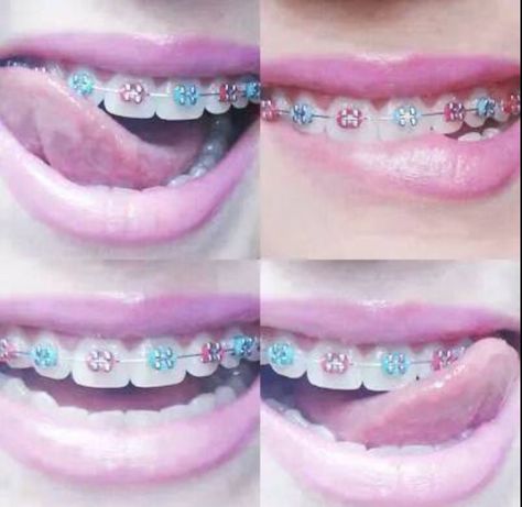 😁 Braces Journey, Braces Colors Combinations, Braces Ideas, Lingual Braces, Cute Braces Colors, Kids Braces, Apply Lip Gloss, Cute Braces, Colors Combinations