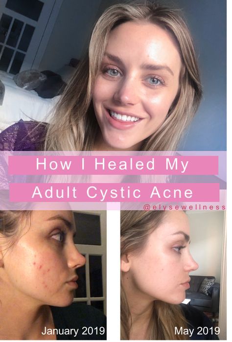 Cystic Acne Routine, Acne In Your 30s, Skin Care Routine For Cystic Acne, Acne At Age 40, Over 40 Acne Skin Care, Spironolactone Before And After, Skin Care Solutions Acne, Get Rid Of Cystic Acne Overnight, Quick Acne Remedies