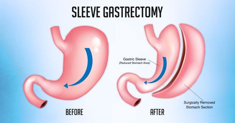 After the Sleeve Gastrectomy, Now What? Expected Results After 1 Year 1 Month Post Op Vsg, Gastric Bypass Sleeve Post Op Liquid Diet, Gastric Bypass Before And After Sleeve Gastrectomy, Dumping Syndrome, Gastric Bypass Sleeve Liquid Diet Post Op, Gastric Bypass Sleeve Reset, Sleeve Gastrectomy, Bariatric Surgeon, Bariatric Diet