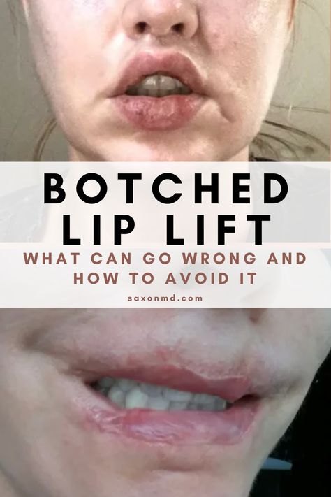 A lip lift can be an amazing procedure that can rejuvenate the lips, but it can go wrong. 

Click through to read about specific botch lip lift stories, learn how to avoid bad outcomes, and possible ways of treating problems if they occur. 

Dr. Saxon is a lip lift expert with offices in Austin and Dallas, TX. 

#lipliftresults #lipfiller #lipflip #lipaugmentation #facialaesthetics #plasticsurgery #lips Lip Lift Before And After, Bad Lip Injections, Lip Lift, Laser Skin Resurfacing, Botox Lips, Lip Augmentation, Bold Lip Color, Neck Lift, Facial Aesthetics