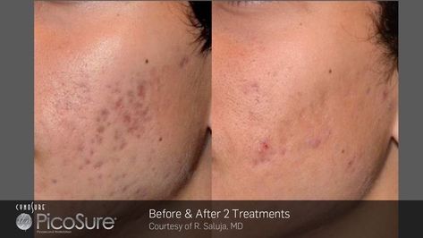 Acne scar removal beauty skincare Laser Acne Scar Removal, Cell Signaling, Laser Skin Rejuvenation, Pico Laser, Laser Facial, Laser Skin Resurfacing, Facial Treatments, Acne Scar, Acne Treatments