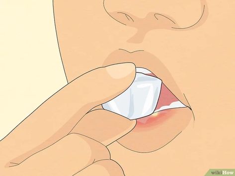 Canker Sore Remedy For Kids, How To Get Rid Of Sores In Your Mouth, How To Get Rid Of Mouth Ulcers, Roof Of Mouth Sore Remedy, Mouth Sore Remedy How To Get Rid, Sore In Mouth Remedies, Roof Of Mouth Sore, Blister In Mouth, Ulcer On Tongue