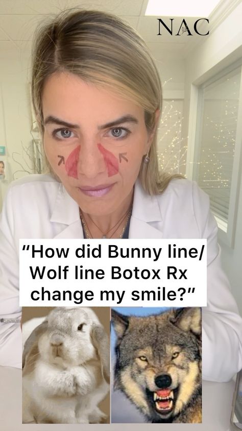 #bunnylines #wolflines #bunnylinebotox #botox #botoxtraining #drbitafarrell #naturalaestheticscenter | Instagram Botox For Marionette Lines, Bunny Lines Botox Before And After, Face Injections, Botox Injection Sites, Botox Training, Botox Before And After, Marionette Lines, Botox Fillers, Iv Therapy