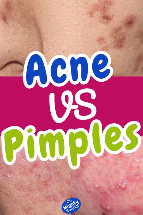 Close-up of facial skin showing various stages of acne and pimples, with inflamed and healing blemishes visible. Pustules Acne, Nodule Acne, Acne Types, Clear Pimples, Redness Pimple, Pimple Causes, Cystic Pimple, Easy Skincare, How To Clear Pimples