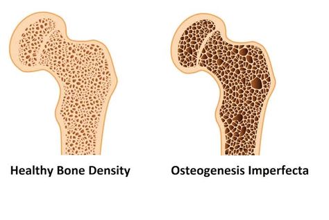 Osteogenesis Imperfecta, School Organization Notes, Bone Density, Healthy Bones, Health Knowledge, Life Expectancy, School Organization, Medicine, Google Search