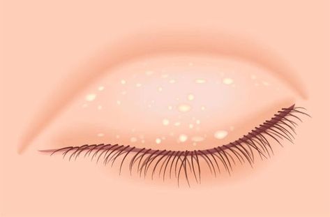 How to Get Rid of Milia (Tiny Bumps on Eyelids) White Bump On Eyelid, Anti Glare Glasses, Lasik Eye Surgery, Eye Twitching, Lasik Surgery, Eye Infections, Upper Eyelid, Eye Prescription, Eye Surgery