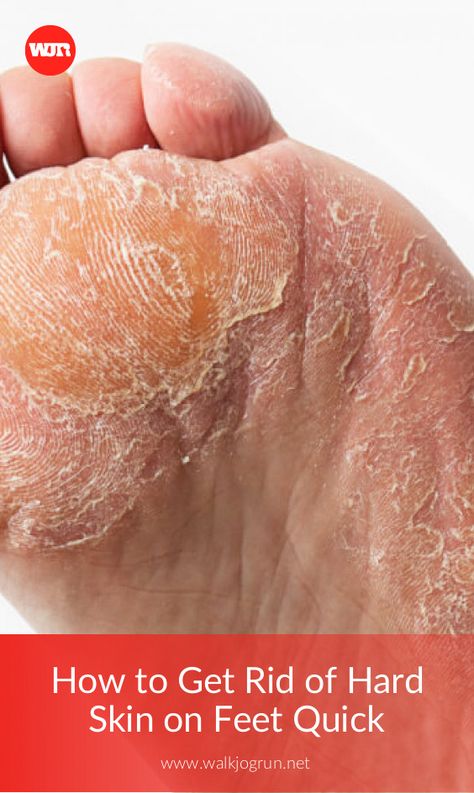 Peeling Skin On Feet How To Get Rid Of, How To Get Rid Of Dry Skin On Feet Heels, How To Get Dry Skin Off Feet, Dry Feet How To Get Rid Of, Peeling Feet Remedy Diy, Dry Calloused Feet Remedy, How To Get Rid Of Dry Feet Skin, Rough Feet How To Get Rid Of, How To Get Smooth Feet At Home