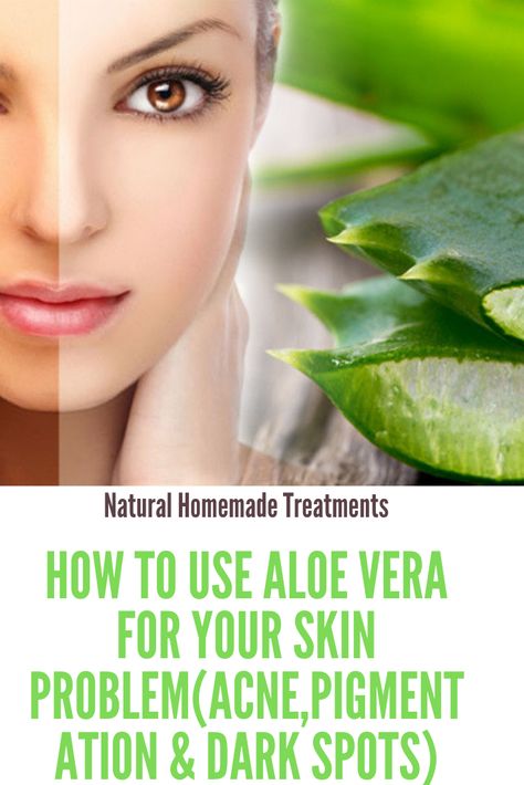 Aloe vera is a miracle for skin problems! In these articles know about how to use aloe vera for acne,pigmentation, dark spots and glowing skin. Aloe Vera For Acne, Benefits Of Aloe Vera Gel, Step By Step Makeup Tutorial, Lemon Face Mask, Benefits Of Aloe Vera, Face Mask Beauty, Honey Shampoo, Step By Step Makeup, Homemade Hair Mask