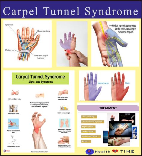 How To Wrap Your Wrist For Carpal Tunnel, Carpel Tunnel Symptoms, Carple Tunnel, Carpel Tunnel Syndrome, Hand Therapy Exercises, Nerve Pain Remedies, Carpal Tunnel Exercises, Medical Radiography, Carpel Tunnel