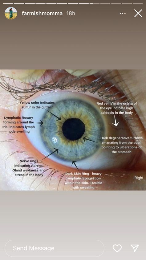 Iridology Chart Eye, Opthalmic Technician, Iridology Chart, Dr Morse, Optometry Education, Eye Facts, Reflexology Chart, Eye Prescription, Medical School Studying