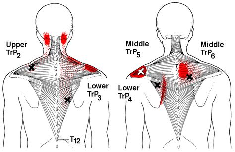 This Muscle Causes Pain In Shoulder Back. See the red areas? Those indicate pain. See the X's? Those are the places to press to get rid of the pain. Punkty Spustowe, Shoulder Stretches, Tight Shoulders, Neck Exercises, Stiff Neck, Upper Back Pain, Trigger Point, Neck And Shoulder Pain, Trigger Points