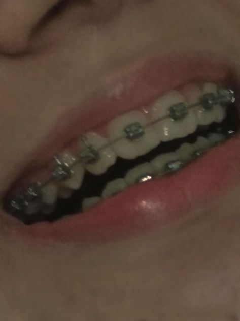 Teeth Vision Board, Perfect Teeth Aesthetic, Brackets Aesthetic, Perfect Teeth Braces, Braces Aesthetic, Pink Braces, Manifesting 2023, Teeth Aesthetic, Cute Braces