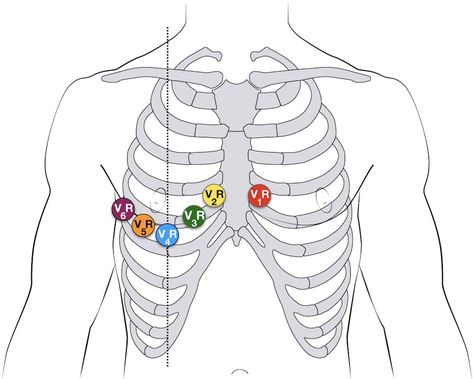 ECG Lead positioning • LITFL Medical Blog • ECG Library Basics 12 Lead Ekg Placement, Ecg Placement, Ekg Placement, Ekg Leads, St Elevation, Ecg Interpretation, Paramedic School, Nursing School Survival, Medical School Studying