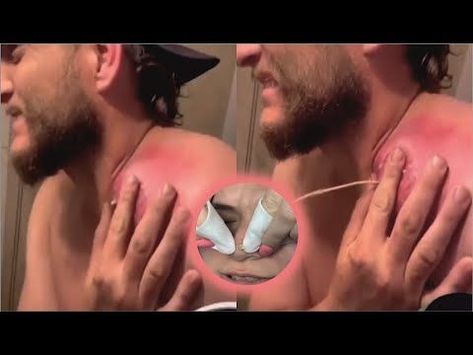 Popping Huge Blackheads and Pimple Popping - Best Pimple Popping Videos 06 Huge Pimple Poppìng, Dr Pimple Poppìng Videos, Pimple Pops Videos, Spot Popping Videos, Huge Blackheads Extraction Videos, Ear Pimple Poppìng Videos, Huge Pimple Pop Video, Arm Pimples, Leg Pimples