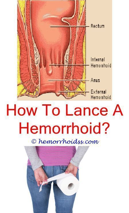 How do I get rid of hemorrhoids in 48 hours? hemorrhoids cream hemorrhoids review what causes hemorrhoids hemorrhoids aafp popped hemorrhoids do hemorrhoids go away hemorrhoids surgery natural recipes for hemorrhoids Thrombosed Hemorrhoid, Hemorrhoid Remedies, Preparation H, Hemorrhoid Relief, How Do I Get, Natural Treatments, Cider Vinegar, Apple Cider, Back Pain