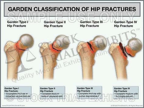 This trial exhibit depicts the standard Garden Classification of Hip Fractures with descriptive labels of each fracture type. Medical illustrations of each hip fracture shows femur fracture type and descriptions, highlighting differences in the anatomy and fracture injury. Femur Fracture, Shin Splint Exercises, Hip Anatomy, Medical Illustrations, Tooth Ache Relief, Hip Fracture, Remedies For Tooth Ache, Anatomy Bones, Bone Fracture