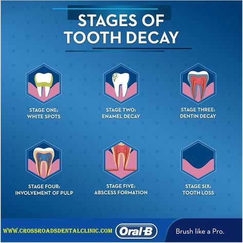 Stages Of tooth Decay....! Save Your Natural tooth with RCT.  Offering Free Consultation. Appointment's are open Now. Call :- 04 3435 424 Whats App :- 058 965 6295. ------------------------------------------------------- #clovedentalclinic #bestcavitydoctors #dxbdentistry #happy #patient #inofficeteethwhitening #homewhitening #opalescence #whiteningtrays #opalescenceboost #oralhealth #brightersmile #healthiersmile #smile Clove Dental, Impacted Wisdom Teeth, Dental Sealants, Black Teeth, Dental Fillings, Dental Cavities, Tooth Pain, Tooth Extraction, Natural Teeth