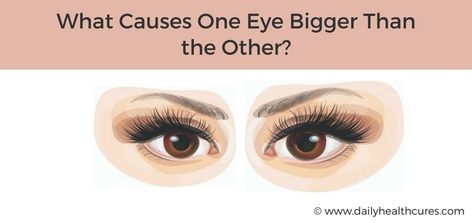 One Eye Bigger Than the Other How To Get Big Doe Eyes, One Eye Smaller Than The Other, One Eye Bigger Than The Other, Make Eyes Bigger, Uneven Eyes, Eye Twitching, How To Get Bigger, Lyrics Of English Songs, Types Of Eyes