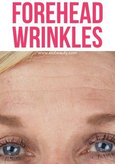 Lines On Forehead, Forehead Wrinkles Remedies, Get Rid Of Forehead Wrinkles, Wrinkle Remedies, Anti Aging Creme, Forehead Wrinkles, Face Wrinkles, Wrinkled Skin, Prevent Wrinkles