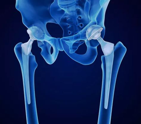 Hip Implants, Hip Dislocation, Adaptive Equipment, Hip Surgery, Medical Laboratory Science, Technology Life, Medication Management, Medical Laboratory, Laboratory Science