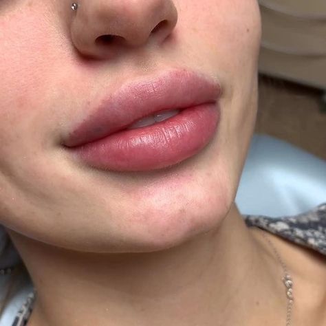 Lip Plumpers That Work, Lip Fillers Juvederm, 1ml Lip Filler, Aesthetic Lip Gloss, Makeup Gift Ideas, Russian Lips, Lips Fillers, Lip Plumpers, Lips Inspiration