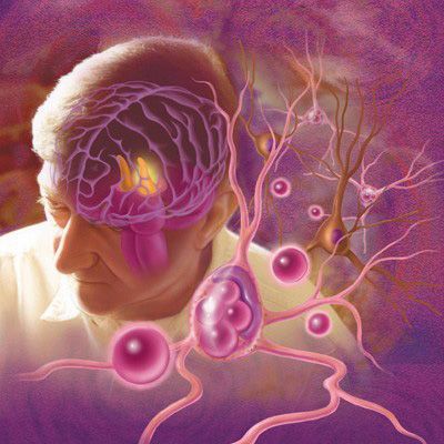 Illustration of Lewy bodies in Parkinson's Disease, by Mary K. Bryson. Explore more work by Mary K. Bryson on the Medical Illustration & Animation Sourcebook online site. #neuroscience #lewybodies #dementia #parkinsons #diseasemanagement #neurology #patienteducation #editorial #medical #illustration #medicalillustration #scientificillustration #medicalillustrator #sciart #medicaleducation #biology #science #scientific Animation Website, Science Artwork, Parkinsons Awareness, Lewy Body, Vascular Surgery, Biology Science, Mary K, Symbol Of Hope, Reconstructive Surgery