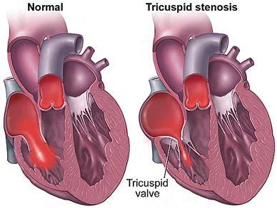 Pediatric Echocardiography, Pulmonary Stenosis, Nursing Ob, Pediatric Cardiology, Nicu Nursing, Sonography Student, Tricuspid Valve, Nursing Fun, Heart Warrior