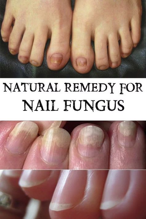 Toenail Fungus Remedies, Nail Fungus Remedy, Fungal Nail, Health Signs, Natural Healing Remedies, Diy Remedies, Toenail Fungus, Natural Therapy, Nail Fungus