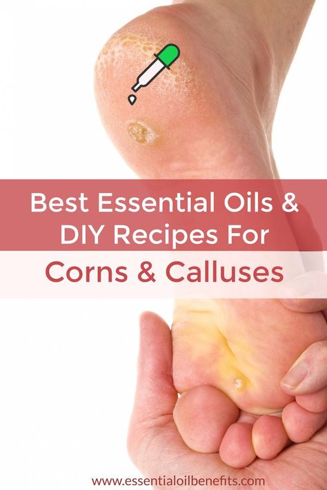 Calluses On Feet Remedies, Get Rid Of Corns, Corn Removal, Diy Essential Oil Recipes, Essential Oils For Headaches, Essential Oil Benefits, Young Living Oils, Naturopathy, Oil Treatments