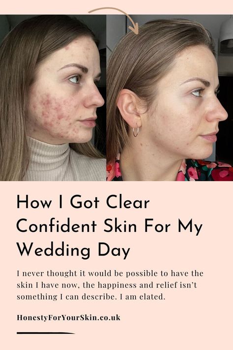 This is how Corrin went from struggling with acne for 6 years to healing her acne in 6 months... see her progress photos and find out what finally worked. #honestyforyourskin #acnetreatment Cheek Acne Cause, Acne On Cheeks, Acne Journey, Clear Skin Remedies, Blemish Remedies, Pimples On Face, Progress Photos, Acne Skincare, Acne Skincare Routine