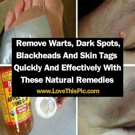 From time to time we all get affected by many skin disorders such as warts, moles. skin tags or dark spots. Fortunately, there are ways to get rid of them that are completely harmless, healthy and natural. Apple Cider Vinegar For Acne, Skin Tags Apple Cider Vinegar, Types Of Warts, Apple Cider Vinegar For Skin, Skin Care Hacks, Remove Warts, Korean Beauty Secrets, Home Remedies For Hair, Skin Tags