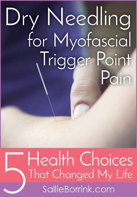 Dry Needling Benefits, Dry Needling Trigger Points, Dry Needling Therapy, Message Therapy, Myofascial Pain Syndrome, Occipital Neuralgia, Acupuncture Benefits, Pain Relief Remedies, Dry Needling