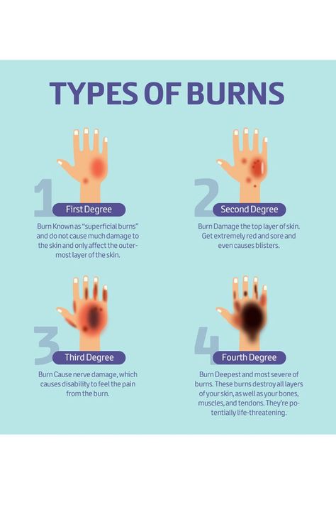 Burn Wound Care, Burns Nursing, Types Of Burns, Emt Study, Wound Care Nursing, Learn Biology, Nursing Information, First Aid Tips, Degree Burns