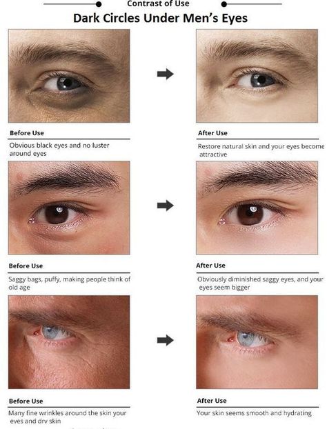 Saggy Eyes, How To Grow Eyebrows, Anti Aging Oils, Under Eyes, Get Rid Of Blackheads, Male Eyes, Makes You Beautiful, Best Anti Aging, Younger Looking Skin